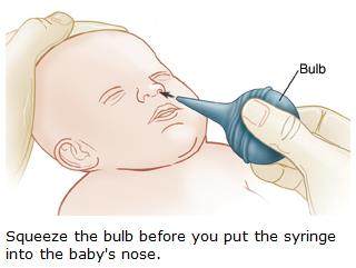 two सक्शन बल्ब ड्रॉपर (suction bulb) से शिशु के बंद नाक का सुरक्षित उपचार
